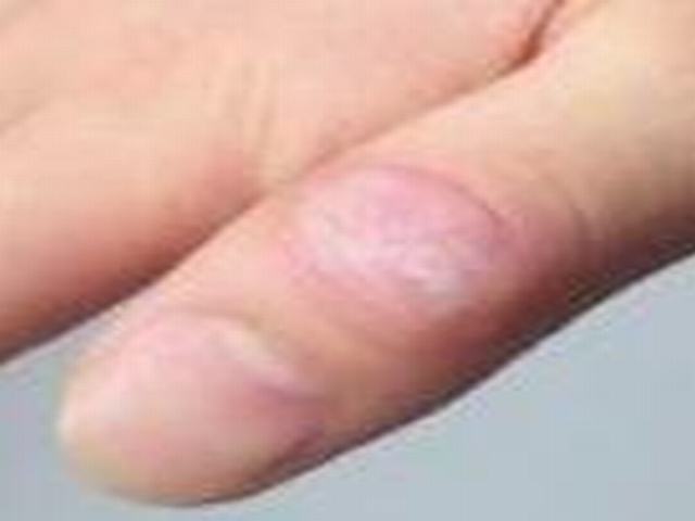 冬季护理硬皮病措施有哪些呢