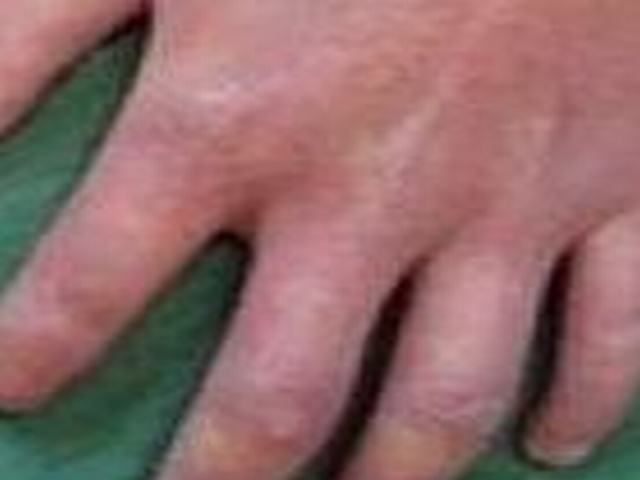 充满性硬皮病的表现有啥 