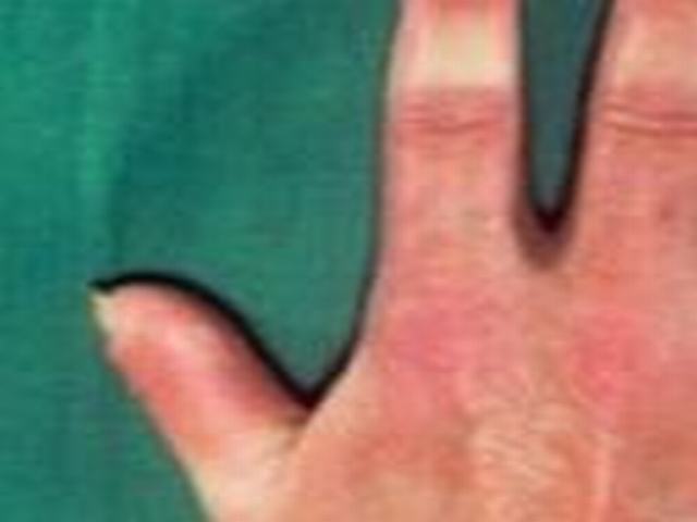 局限性硬斑病的危害有哪些体现
