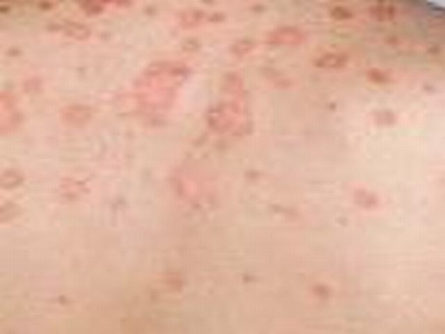银屑病在无察觉中悄悄来临怎么办已经成为一部分病人所关怀的疑问 