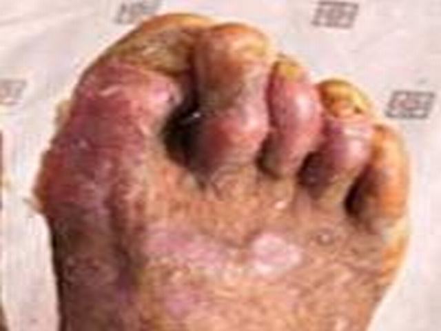 银屑病用半条命与病魔苦战的硬汉