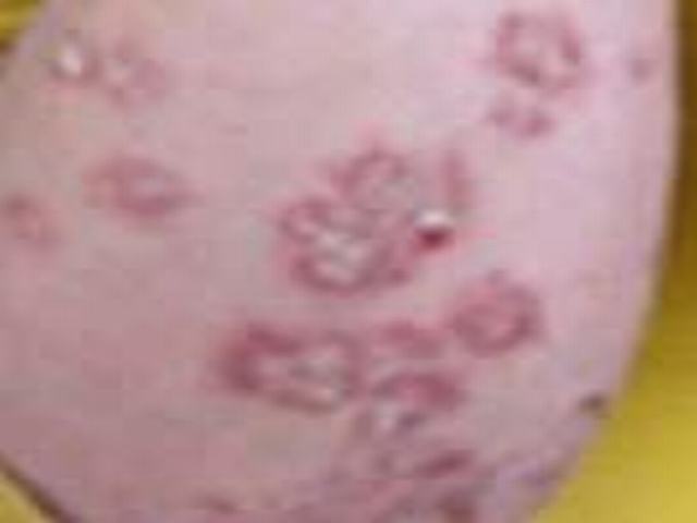 关于银屑病你清楚吗