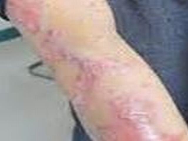 环孢菌素治疗银屑病有哪些不良现象