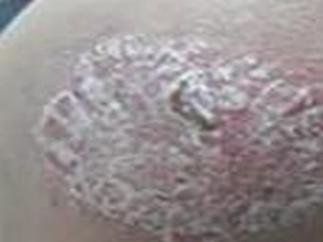 代谢障碍作用银屑病