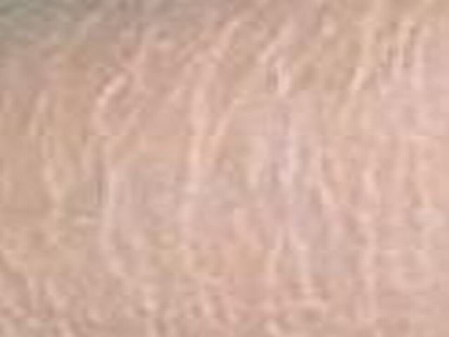 儿童患有鱼鳞病要如何护理 