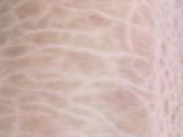 不一样类型的鱼鳞病都包含啥体现