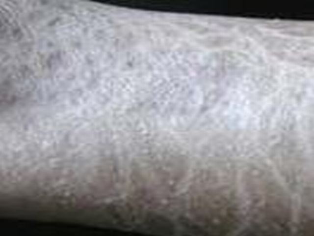 不一样类型的鱼鳞病症状是哪些呢
