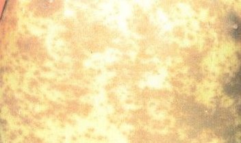 免疫性扁平苔藓的皮肤伤害特点是啥