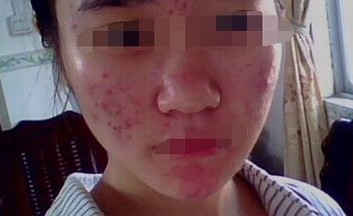 大的痘痘显示后能不能弄破