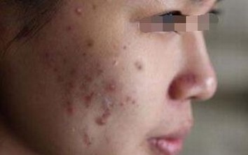 春季油性皮肤  怎样除掉青春痘 
