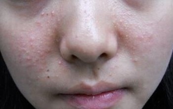 鼻子上长痘是哪些要素  (2)