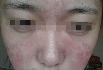 背部长痘痘的病因