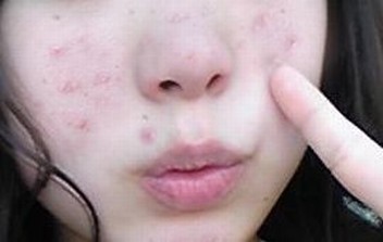 痘疤构成的要素都是啥_痤疮
