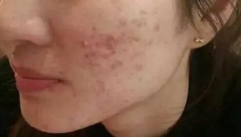 别让青春痘成为青春的可惜