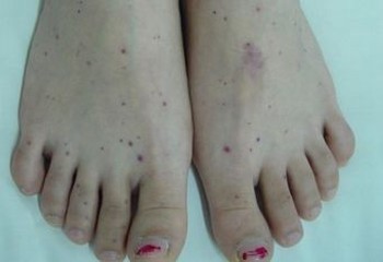 过敏性紫癜都包含什么呢病态反应