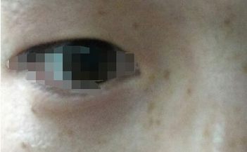 除掉黄褐斑的小妙招 