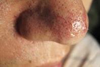 酒渣鼻的症状特点有哪些