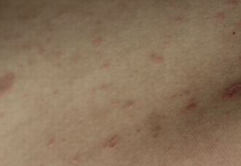 玫瑰糠疹有哪些预防的措施
