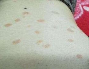 玫瑰糠疹显示前后的症状