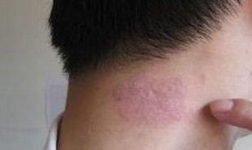 脓疱型牛皮癣的病因是啥