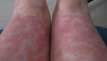 脓疱型牛皮癣的发病特点是啥