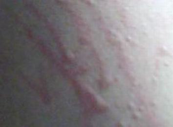 皮肤过敏毁了学业