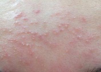 皮肤过敏有哪些常见危害