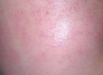 皮肤过敏有什么危害呢