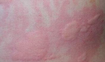 皮肤过敏是哪些要素导致的