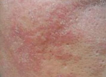 皮肤过敏常常看见的症状有哪些呢
