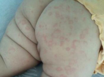 皮肤过敏的人要如何保养