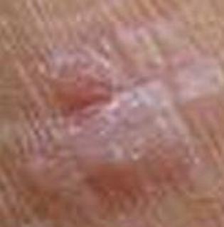 扁平疣的发病受哪些因素作用 