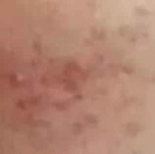 痤疮皮肤如何改善