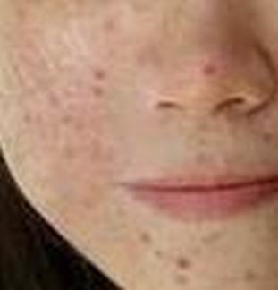 痤疮感染的三个主要起因 