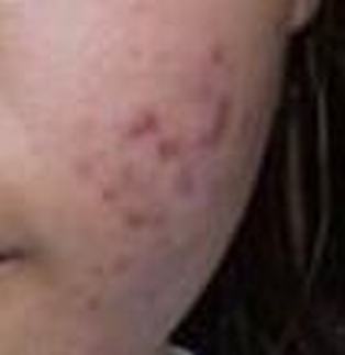 痤疮患者需注意5大护理事项