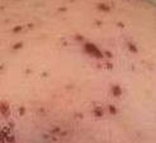 带状疱疹还是属于性病吗