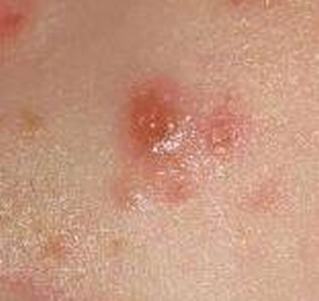 带状疱疹会并发的疾病有哪些 