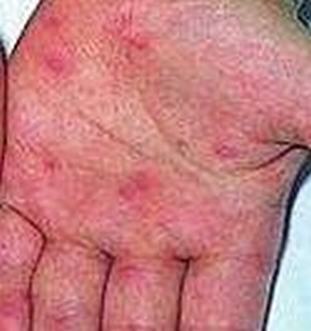 带状疱疹的诊断结论是如何的