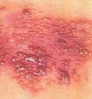 带状疱疹的症状有哪些