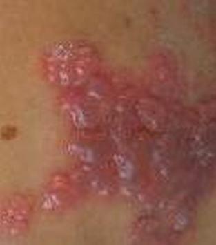 带状疱疹的主要危害