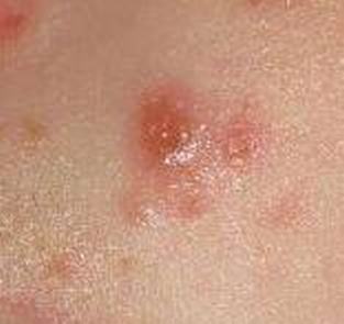 带状疱疹对患者身体有什么危害
