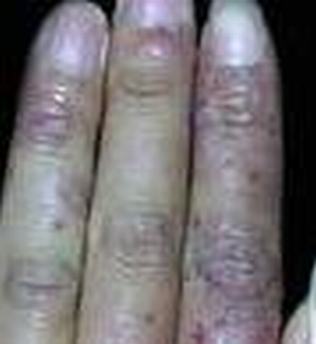 冻疮预防方法有哪些