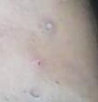 妙招大实用让整个夏季不长痘