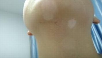 白癜风的发病和职业有关吗