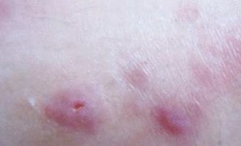 带状疱疹的多样表现