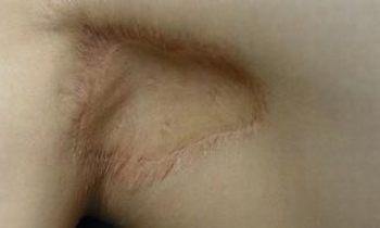 常常看见的狐臭病因