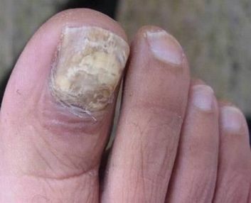 灰指甲给患者带来什么危害