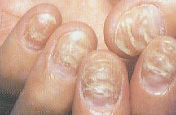 灰指甲对女患者的伤害有什么 