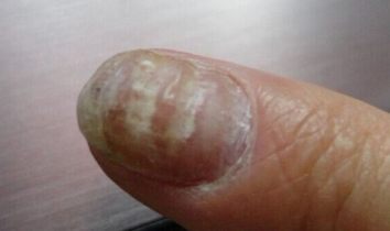 灰指甲的症状累及表现有哪些 