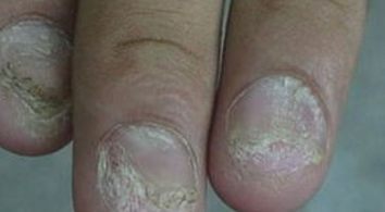 灰指甲的症状及原因